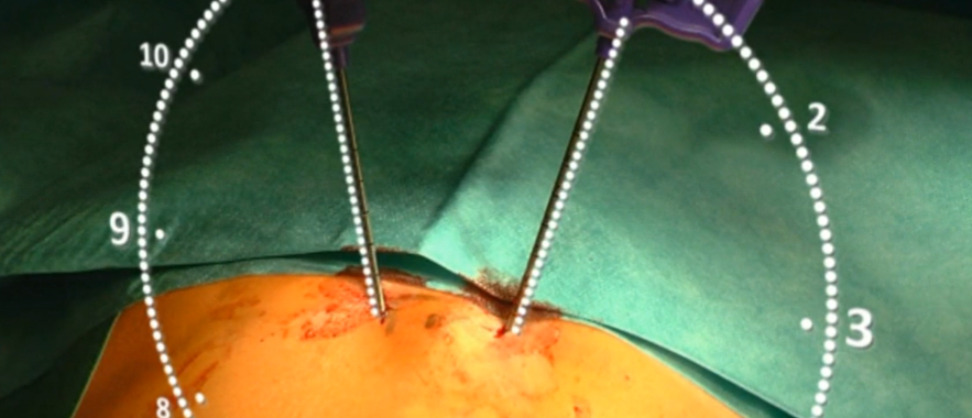 Balloon kyphoplasty of T8 in an osteoporotic fracture