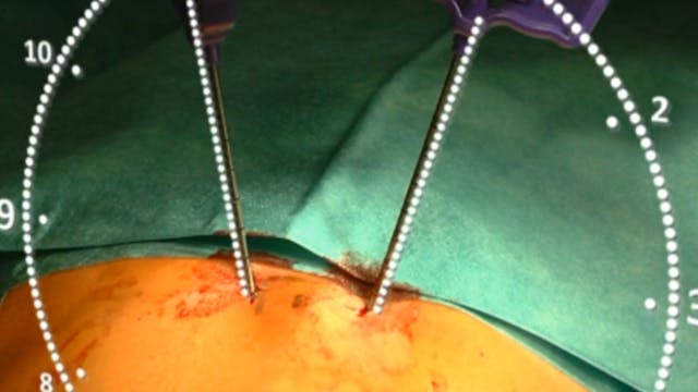 Balloon kyphoplasty of T8 in an osteo...