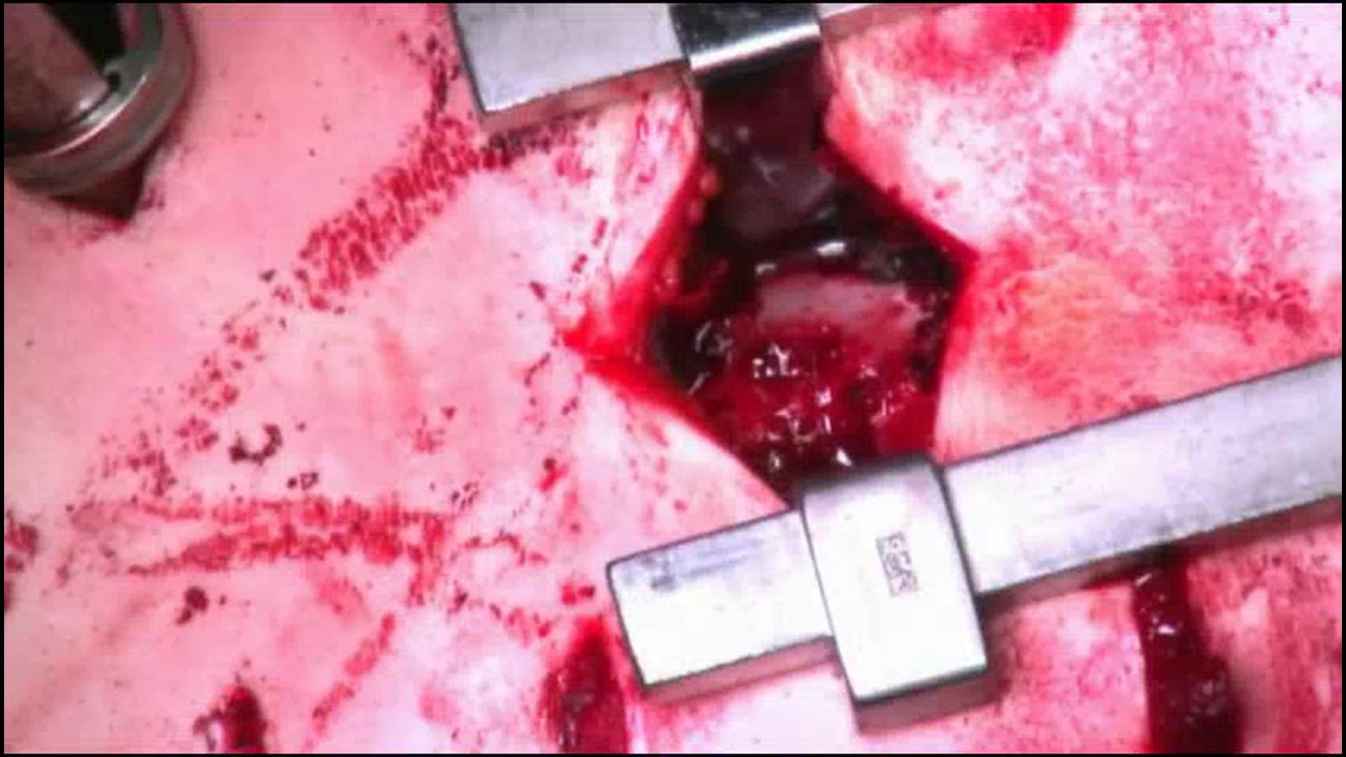 Percutaneous three column osteotomy for kyphotic deformity correction in ......