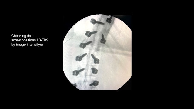 Trailer Posterior correction and fusion of an Adult Idiopathic Scoliosis 