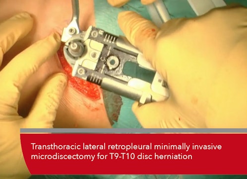 Teaser Transthoracic lateral retropleural minimally invasive microdiscectomy ...