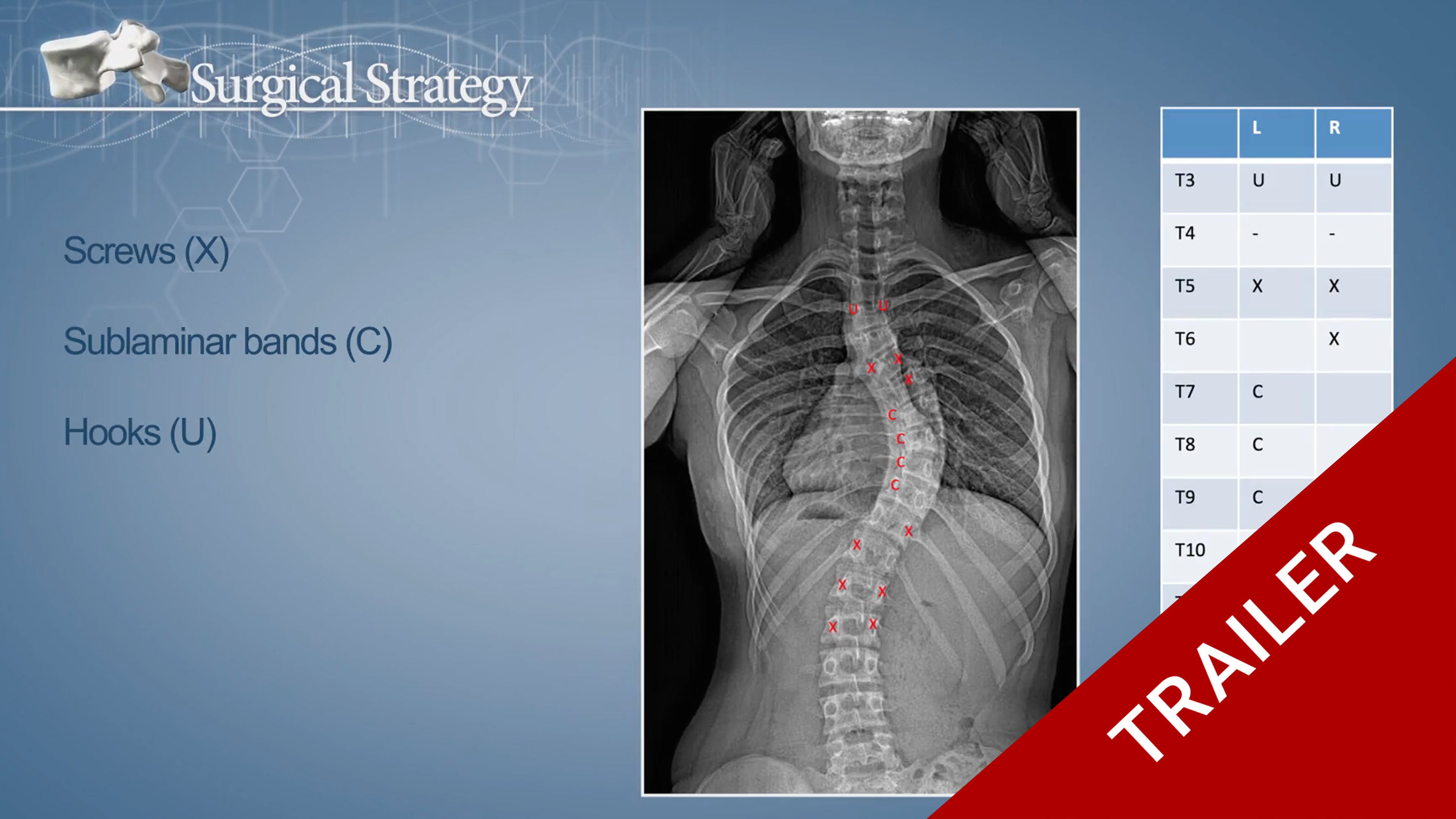 Trailer Correction of an AIS with a hybrid technique of pedicle screws..