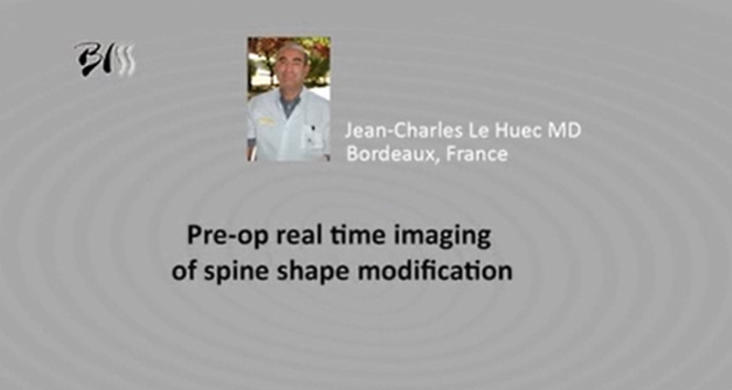 Pre-op real time imaging of spine shape modification