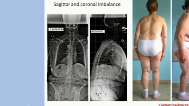 Sagittal and coronal imbalance; case ...
