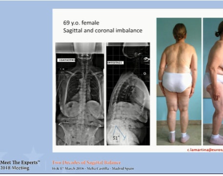 Sagittal and coronal imbalance; case presentations