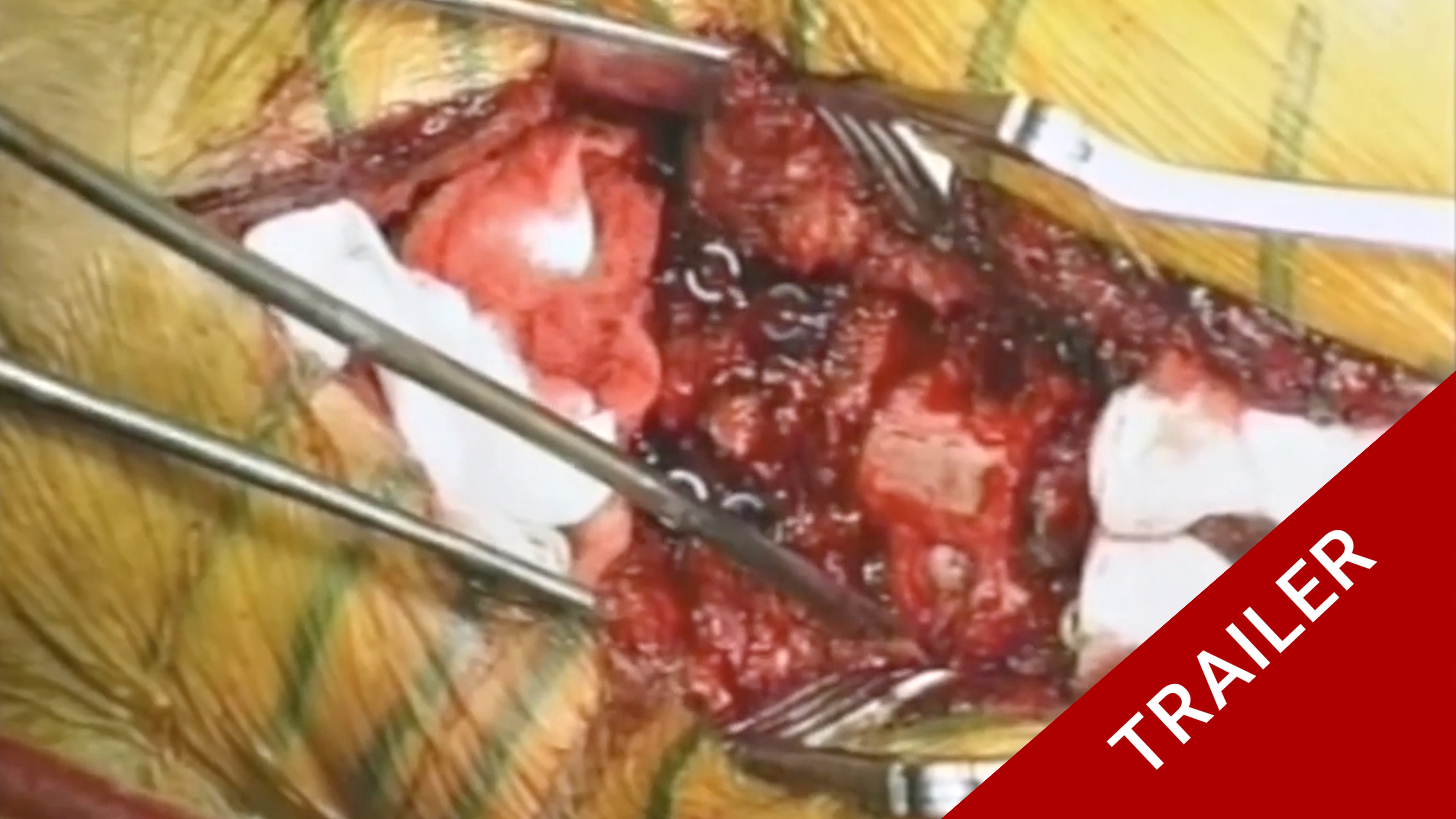 Trailer Masterclass 5.2 Ankylosing Spondylitis of the cervical spine