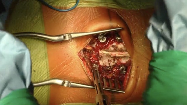 Trailer Lumbar hemivertebra resection by posterior approach for congenita...