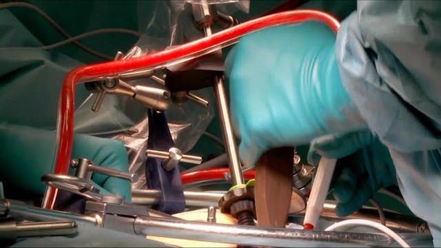 Vertebral body replacement in the tho...