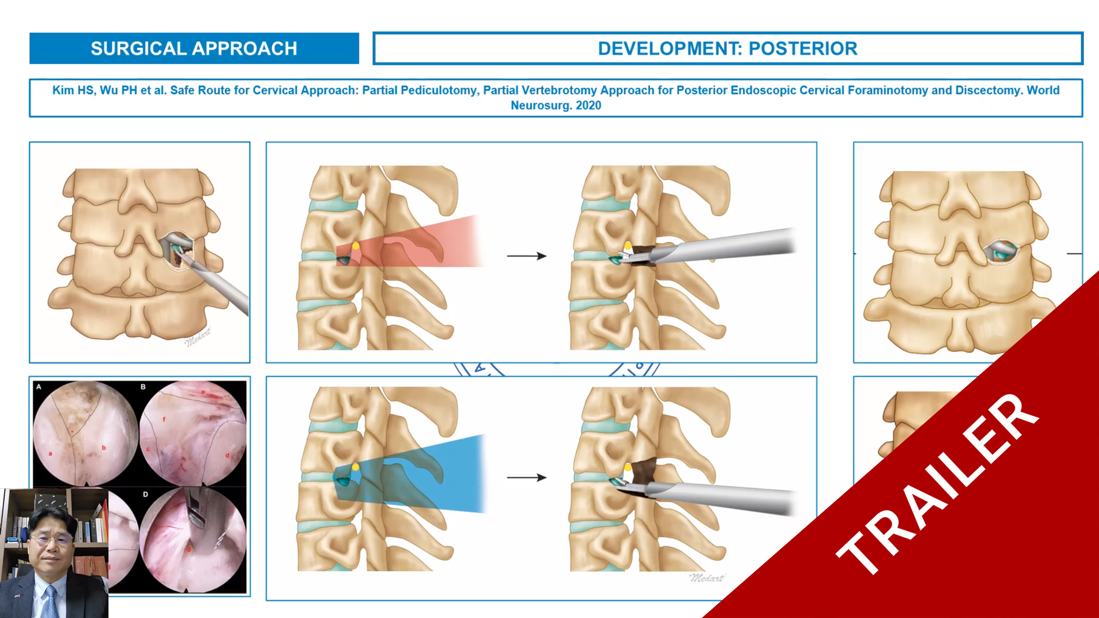 Trailer Anatomical consideration of posterior endoscopic cervical foraminotomy