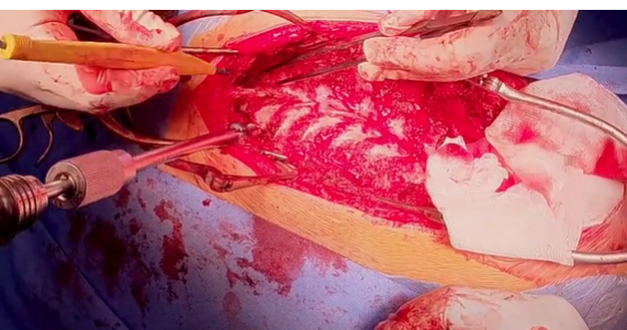 Adolescent idiopathic thoracolumbar scoliosis