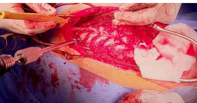 Adolescent idiopathic thoracolumbar s...