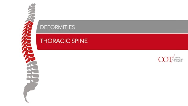 Thoracic spine - Deformities
