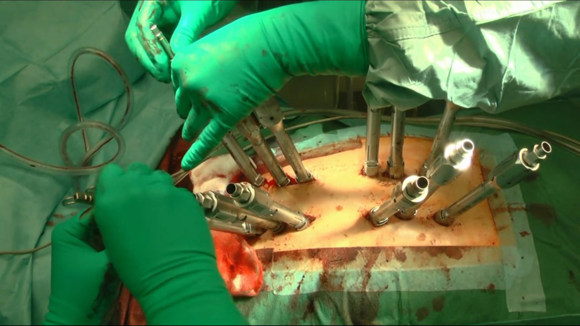Percutaneous stabilization of a T9/10 fracture in a patient with ankylosing..