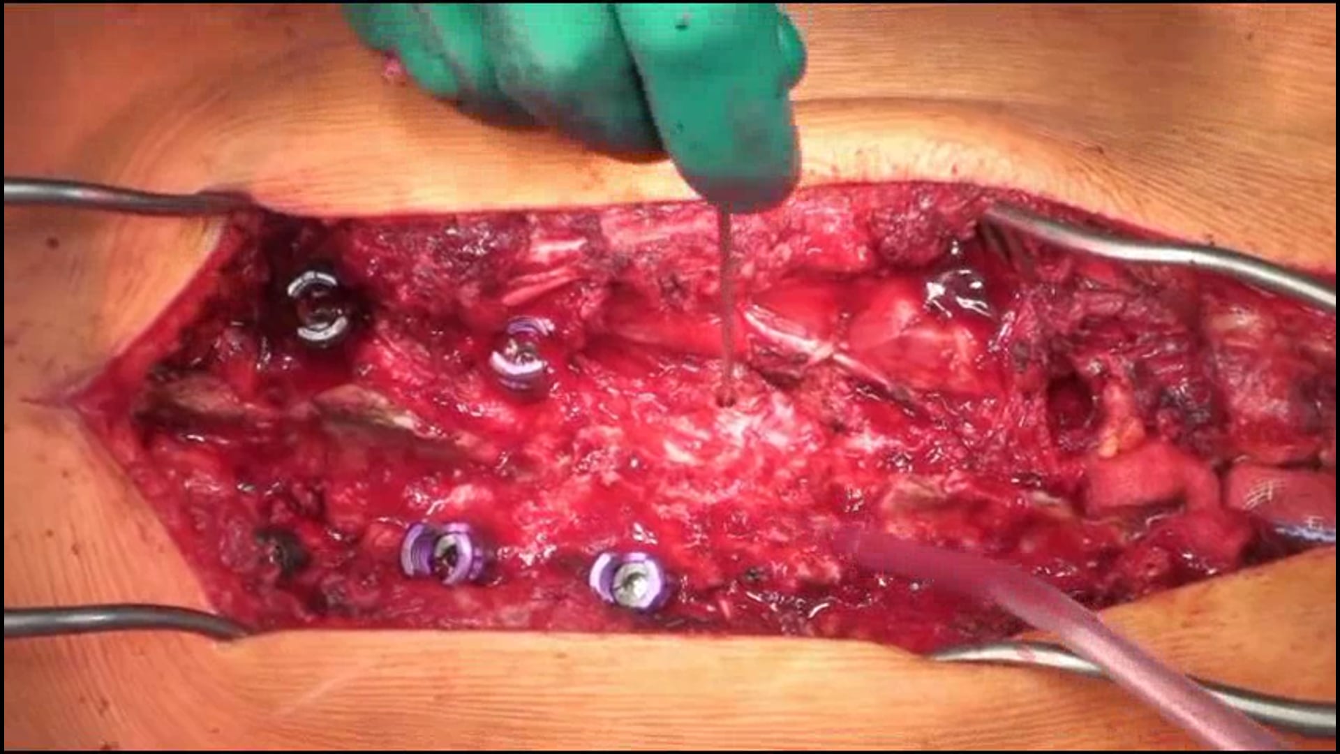 Pedicle subtraction osteotomy for correction of congenital scoliokyphosis