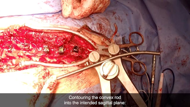 Trailer Th6-L4 Correction and Spinal ...