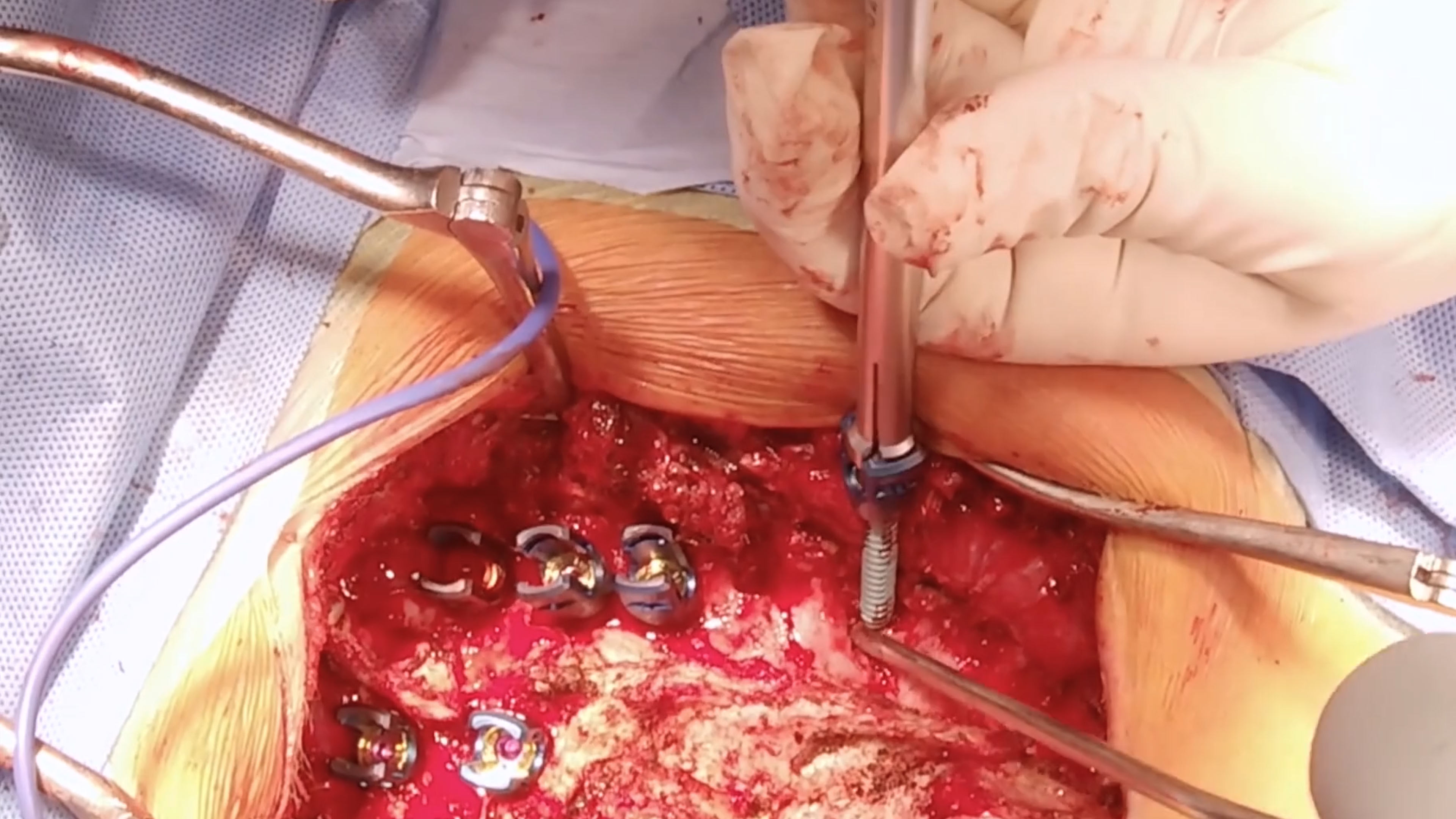 Congenital Thoracic Scoliosis