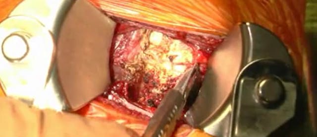 C6-C7 cervical disc arthroplasty in c...