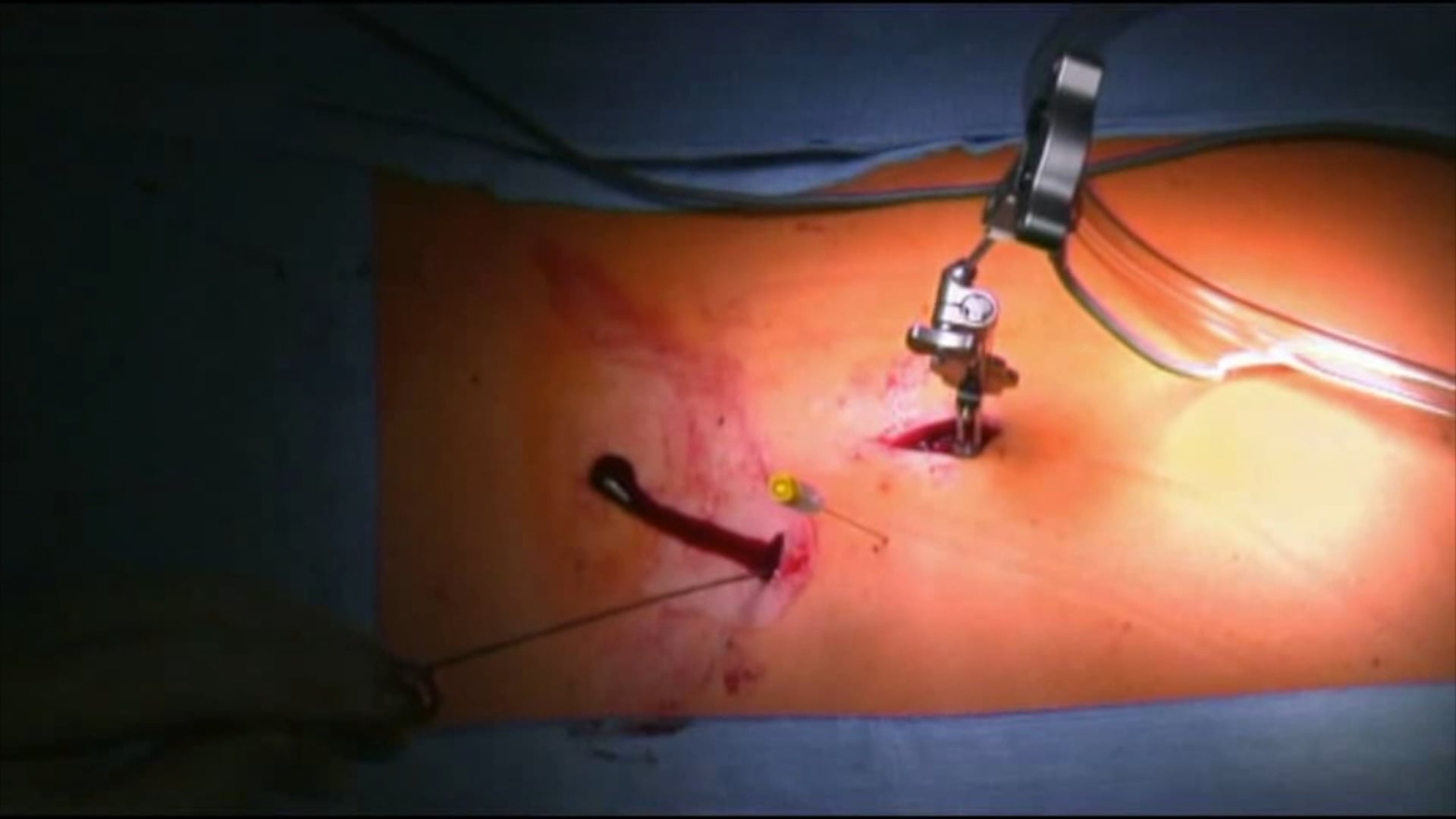 Trailer Percutaneous three column osteotomy for kyphotic deformity correction...