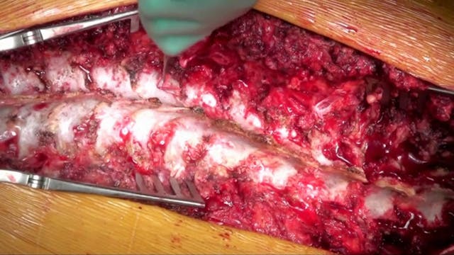 Surgical correction of double major a...