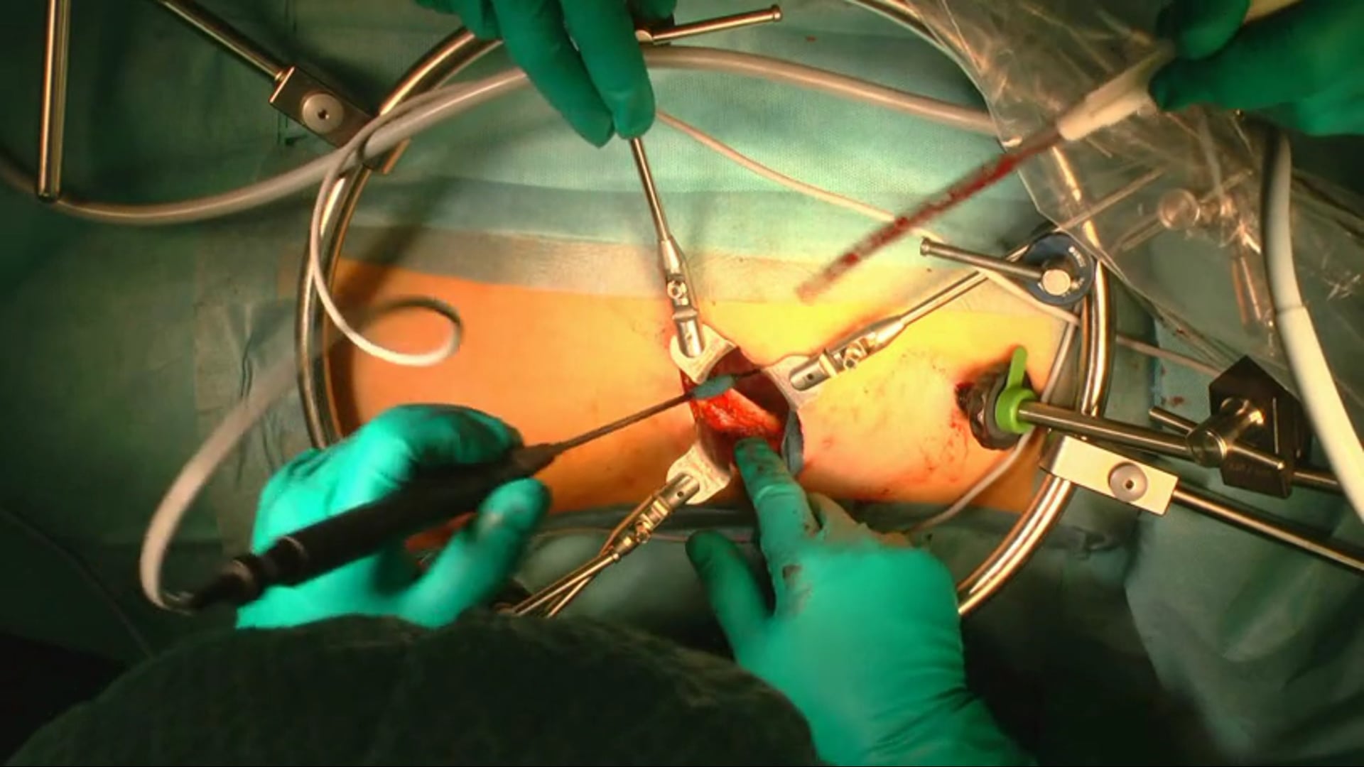 Transthoracic mini-open approach for anterior monosegmental stabilization