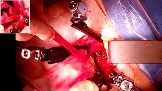 Surgery for distal junctional failure with pelvic pull-out and ALIF cage dislod.