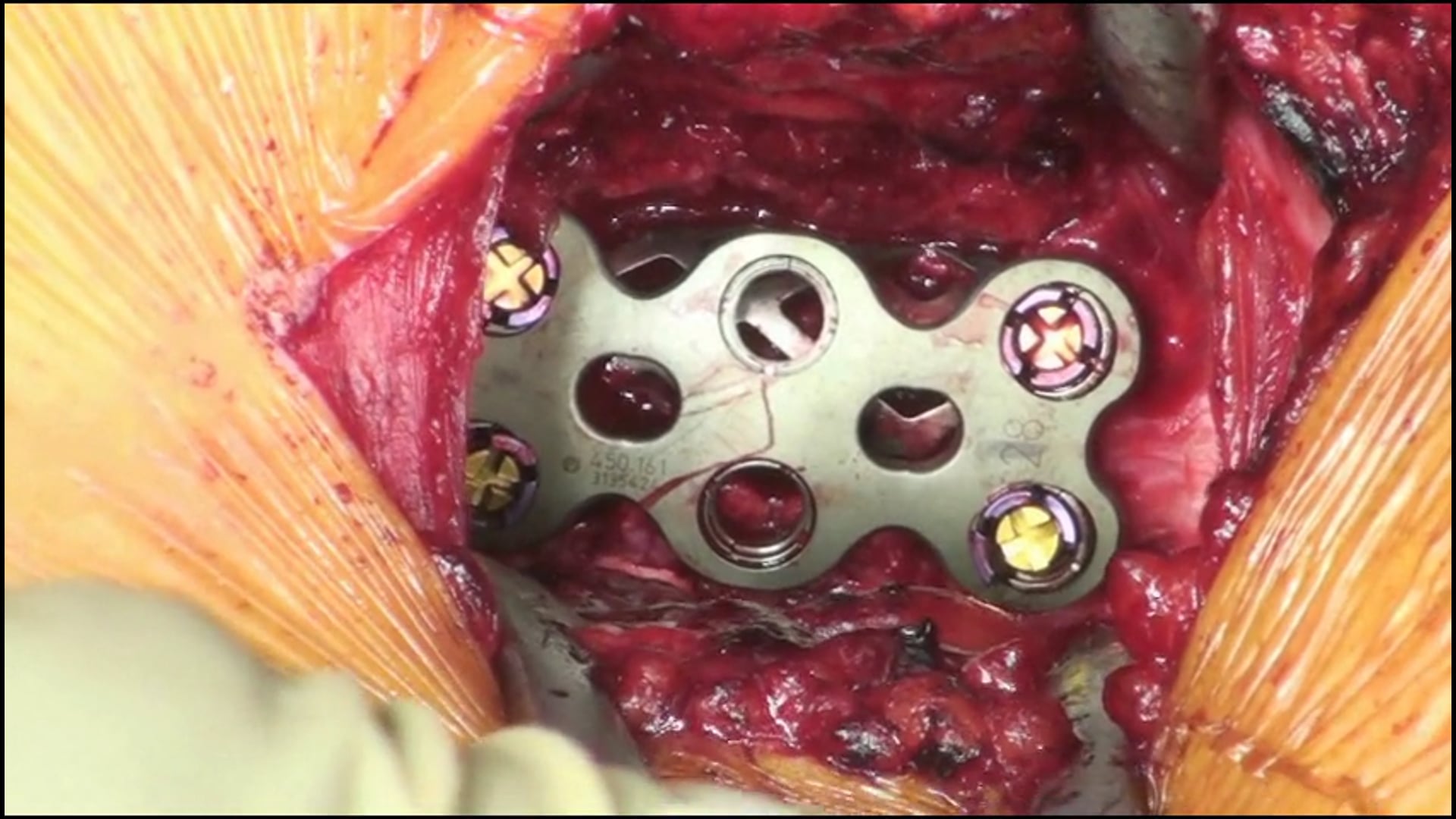 Anterior cervical decompression, corpectomy and fusion