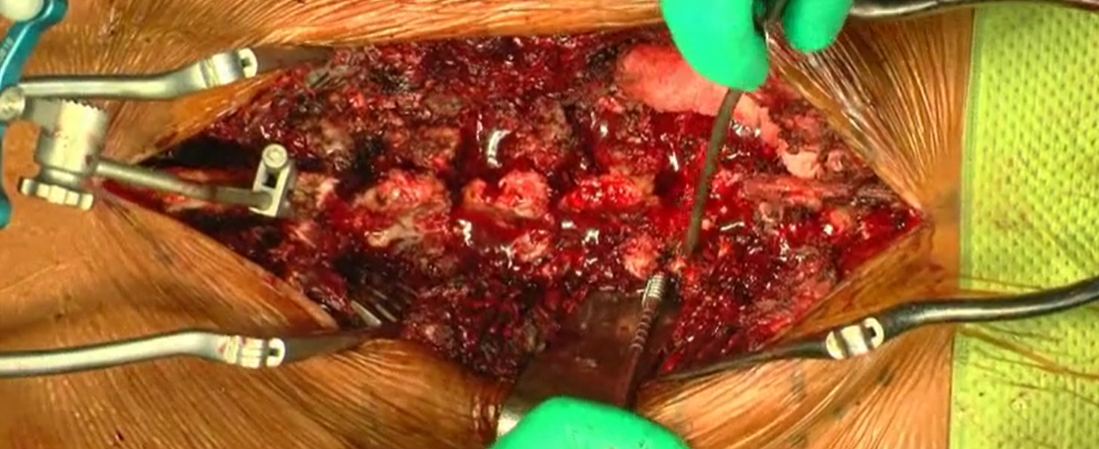 Pedicle subtraction osteotomy for sagittal imbalance