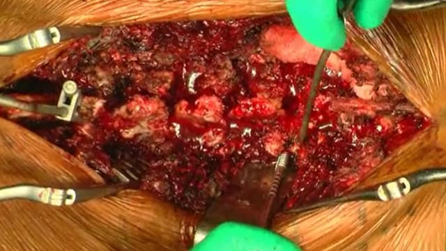 Pedicle subtraction osteotomy for sag...