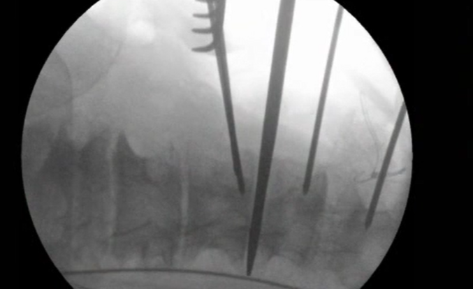 360° release and in situ bending correction for sagittal imbalance, part 1