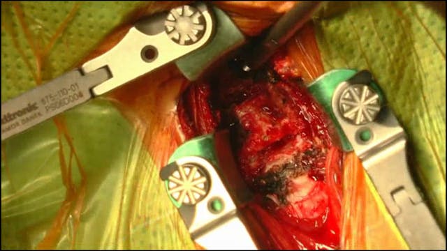 C4 anterior cervical corpectomy with ...