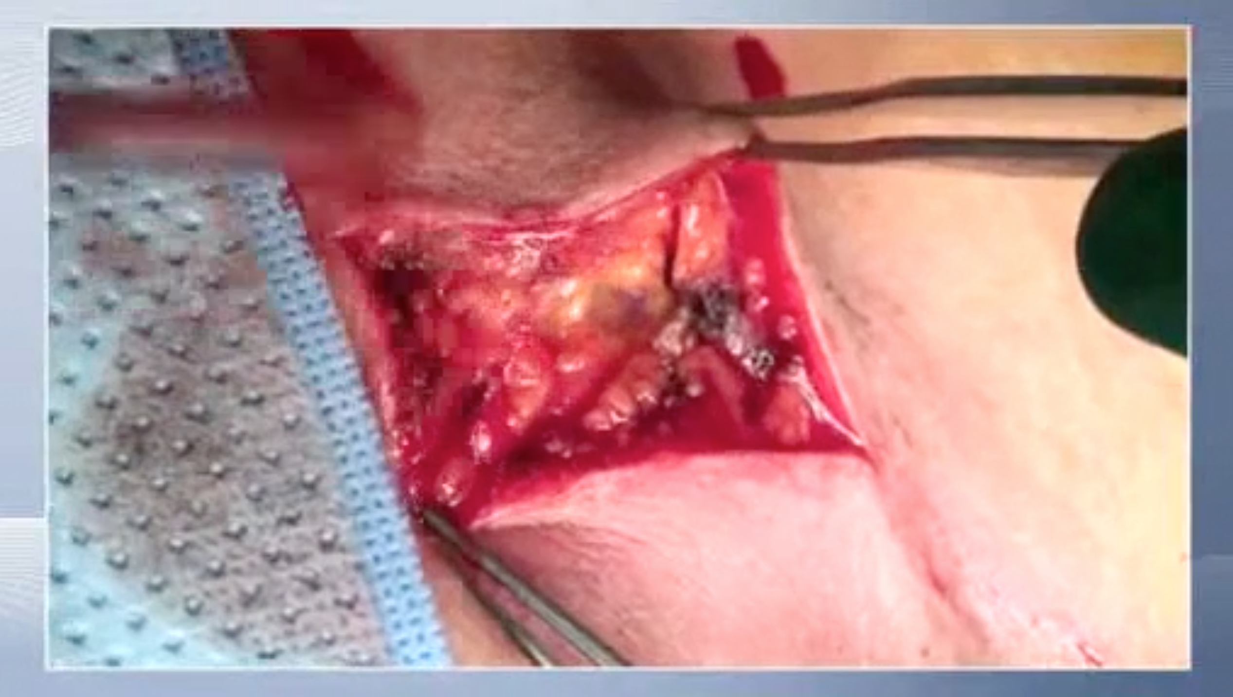 Trailer Posterior-anterior resection of a cervical spine osteoblastoma