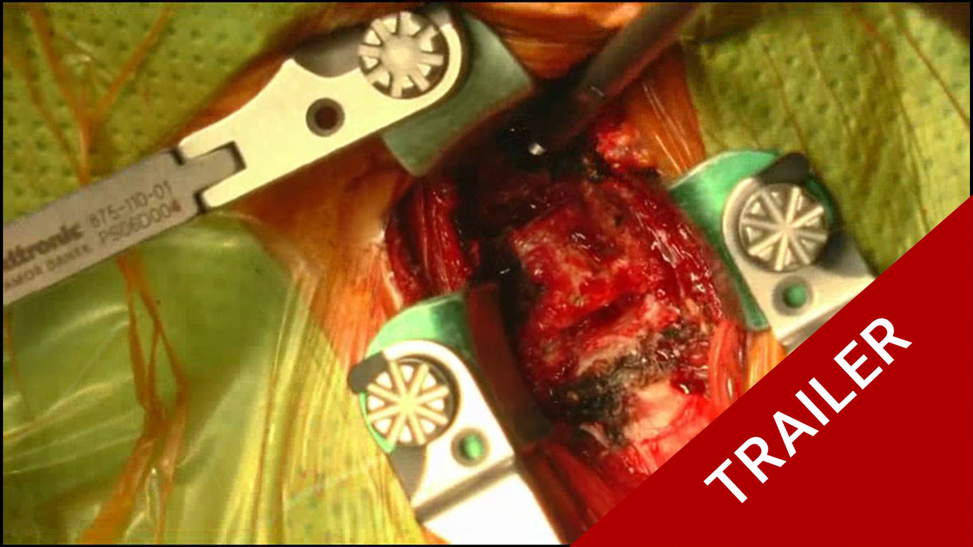 Trailer C4 anterior cervical corpectomy with fusion for cervical spondylotic ...