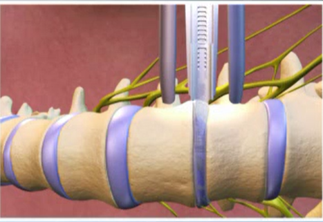 Minimally Invasive Lateral Transpsoas Approach For Lumbar Interbody ...