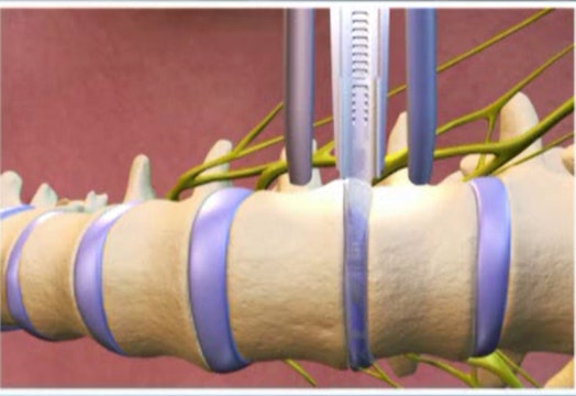 Minimally invasive lateral transpsoas approach for lumbar interbody fusion