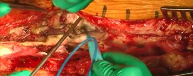 Pedicle subtraction osteotomy for postoperative flat back and sagittal imbalance