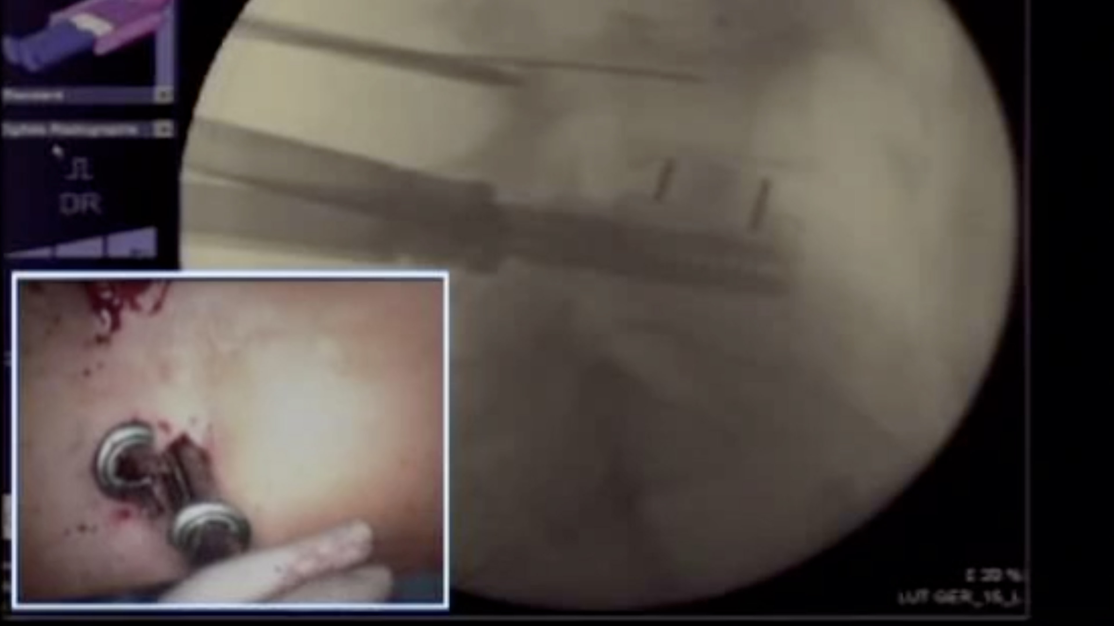 Trailer Percutaneous scoliosis surgery