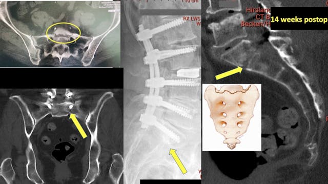 Sacral/pelvic insufficiency fractures...