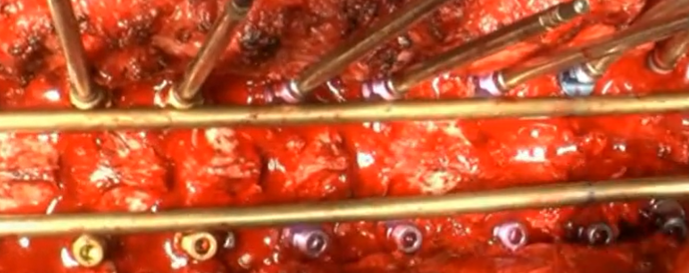 Posterior spinal fusion and correction of Scheuermann kyphosis