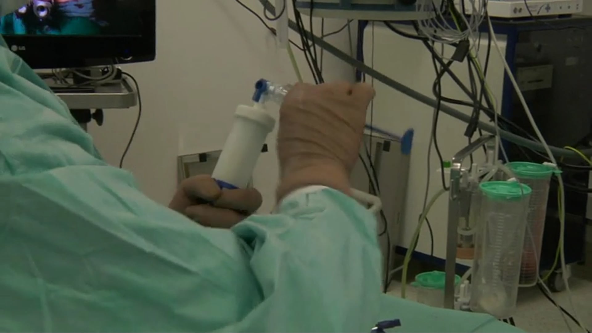 Osteoporotic L1 burst fracture