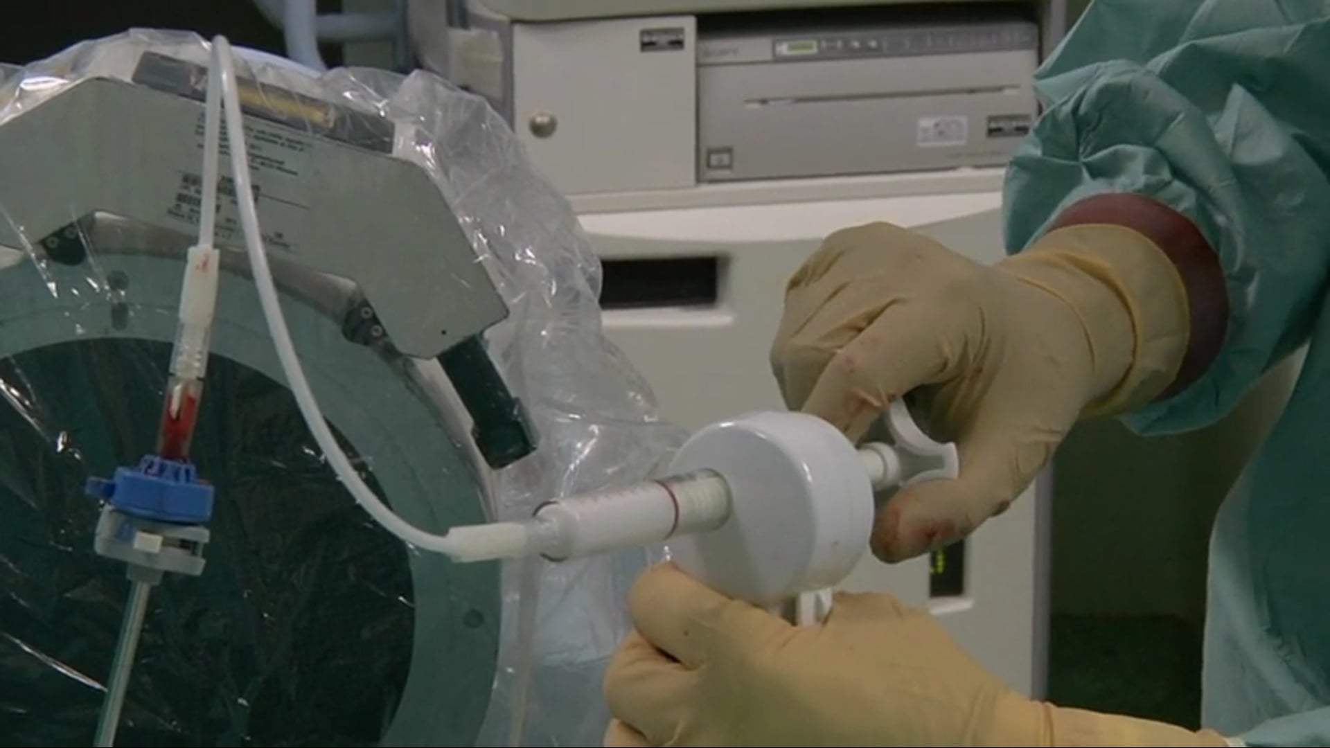 Treatment of T12 osteoporotic vertebral compression fracture