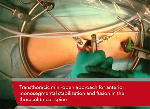 Teaser Transthoracic mini-open approach for anterior monosegmental...