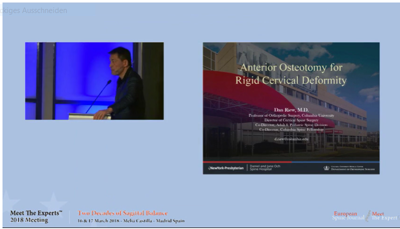 Anterior osteotomy for rigid cervical deformity