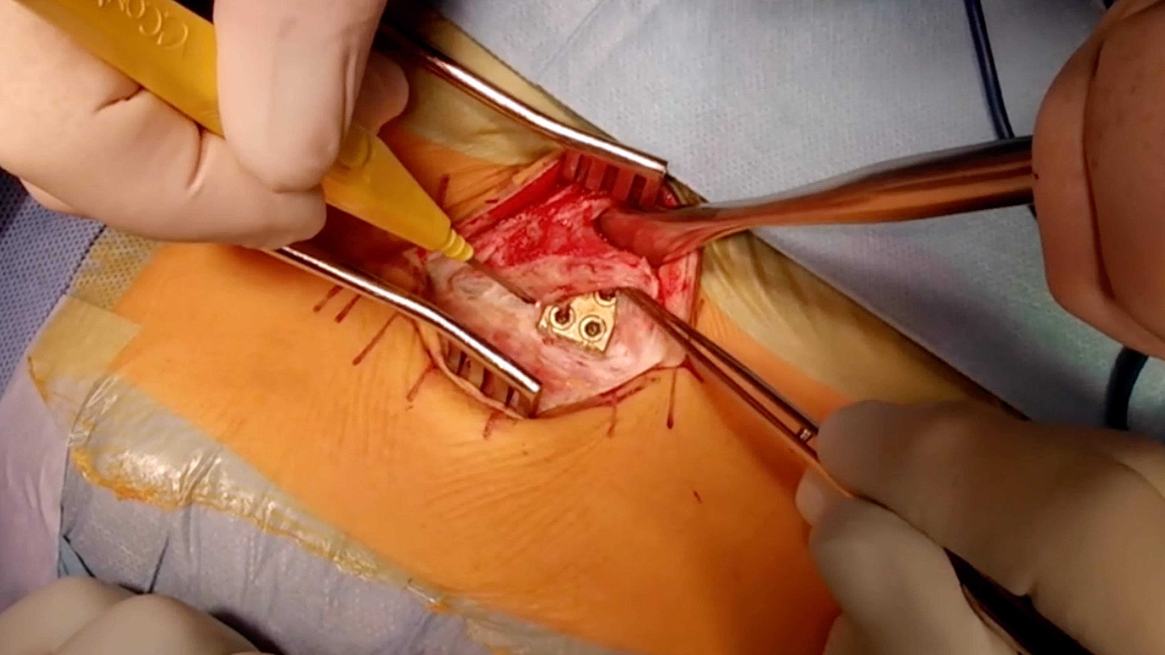 Growing Rod In Early Onset Scoliosis (EOS)