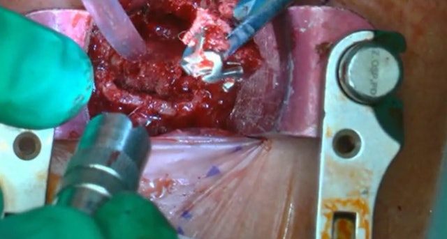 Anterior multiple cervical corpectomy and fusion in revision surgery