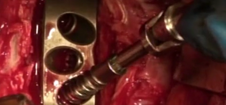 Hybrid stabilization with ALIF L5-S1 and total disc replacement L4-L5