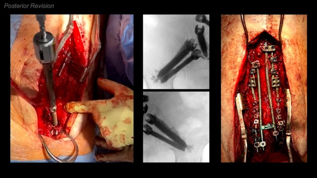 Trailer OOT Posterior and anterior revision of iliac pullout and alif cage...
