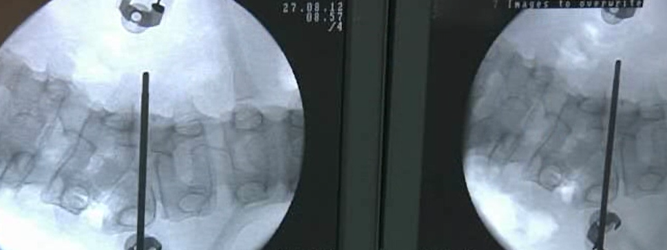 Lumbar hemivertebra resection by posterior approach for congenital scoliosis