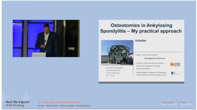 Osteotomies in ankylosing spondylitis...