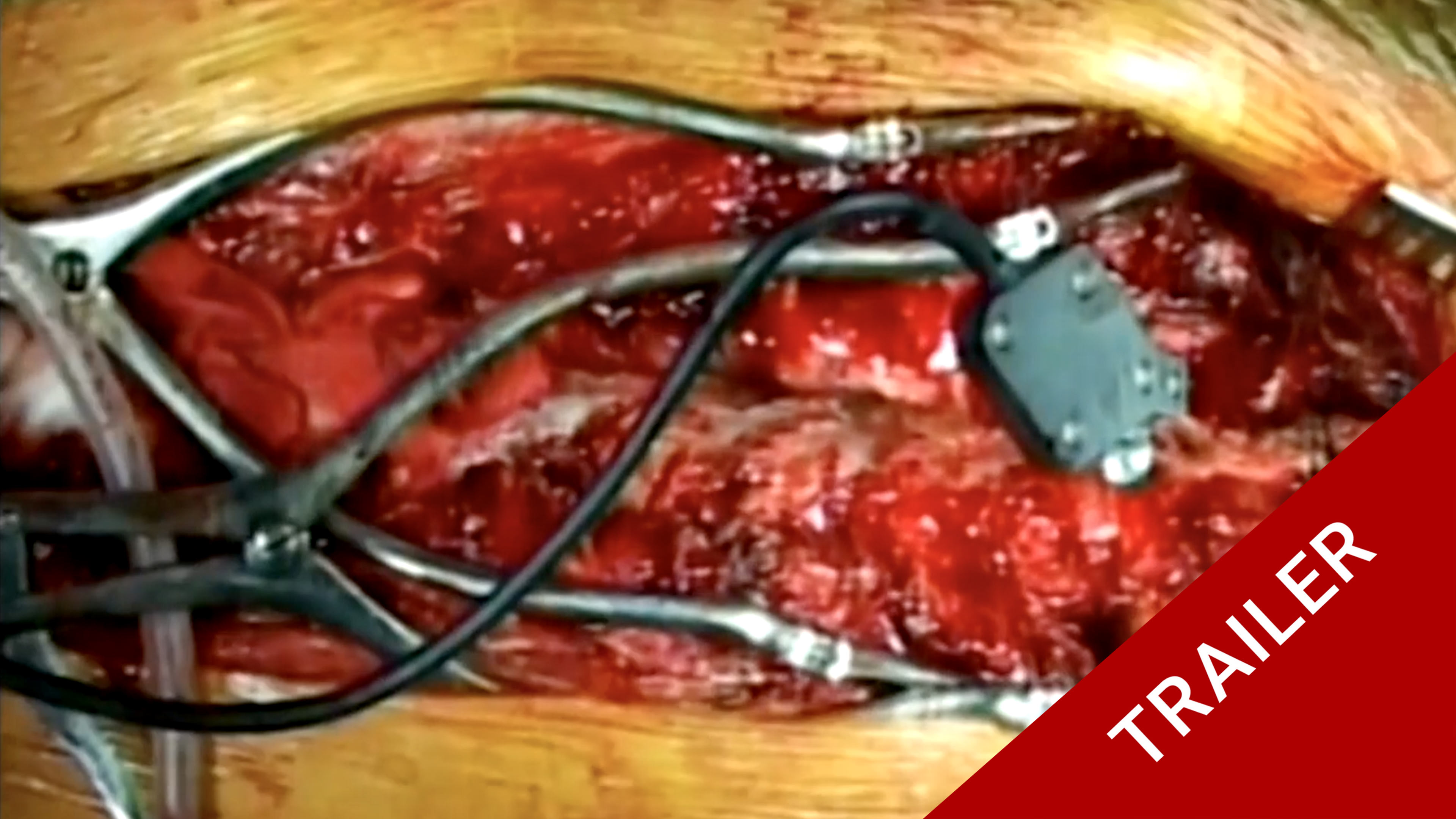 Trailer Masterclass 5.4 Scheuermann's Kyphosis correction with CT guided navig