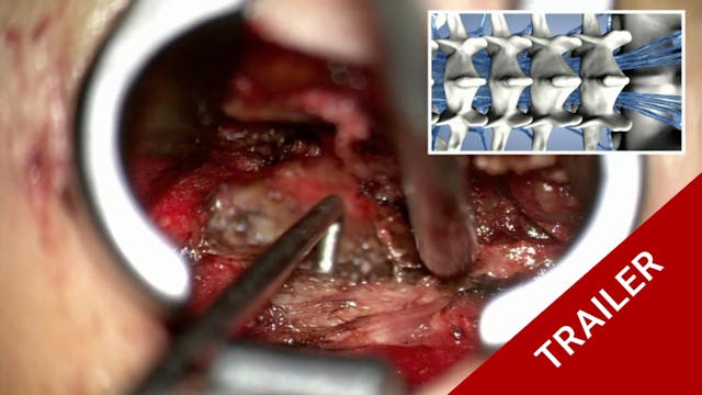 Trailer Lumbar sequestrectomy via a t...